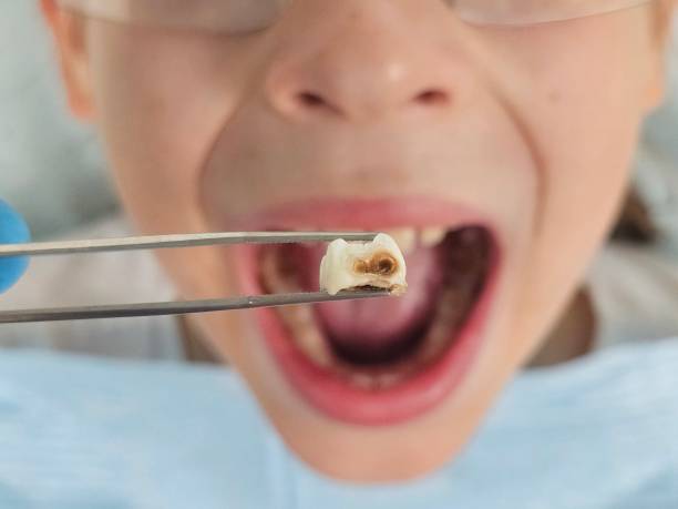 Best Root Canal Emergency Dentist  in Broussard, LA
